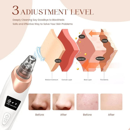 5 in 1 Electric Blackhead Remover Machine